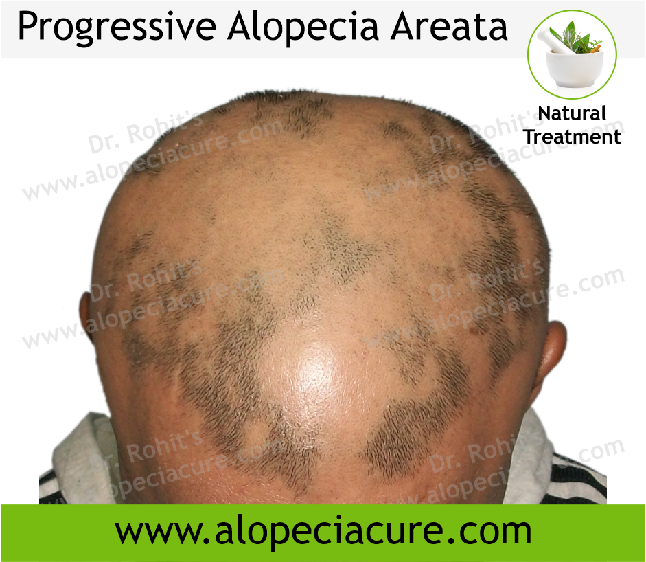 Primary Alopecia Areata